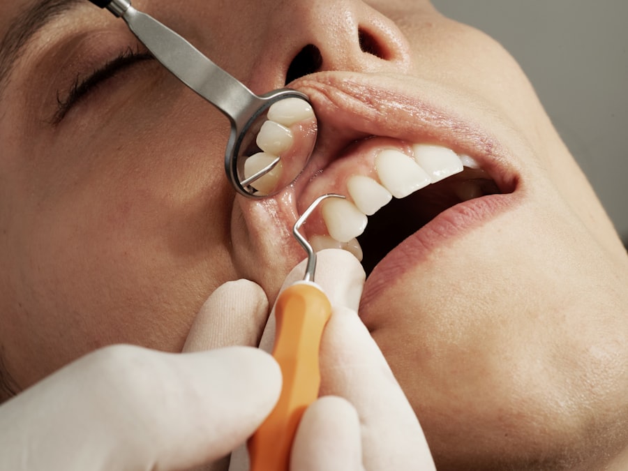 Laser Teeth Whitening at Al-SHIFA Dental Clinic
